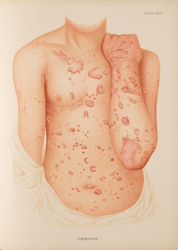 Ein Buchumschlag mit einer Illustration eines Männerkörpers mit roten Flecken, die likely Psoriasis anzeigen, neben Text über die Bedingung.