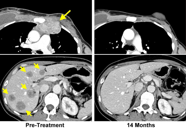 CT-Aufnahme der Brust eines Patienten mit einem gelben Pfeil nach links und einem schwarz-weißen Hirnbild mit der Beschriftung "vor der Behandlung" und "14 Monate".